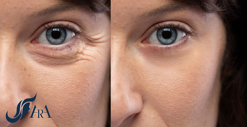 چین و چروک‌های دور چشم، پف دور چشم و تیرگی دور چشم می‌توانند ظاهری پیر و خسته به شما بدهند. هایفوتراپی دور چشم یک روش غیرتهاجمی و موثر برای جوانسازی پوست اطراف چشم است که می‌تواند این علائم پیری را کاهش دهد.