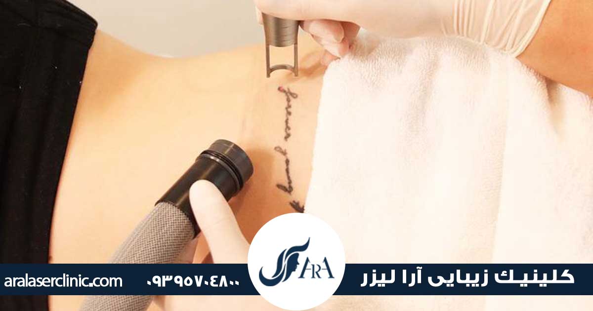 قیمت پاک کردن تاتو در فردیس