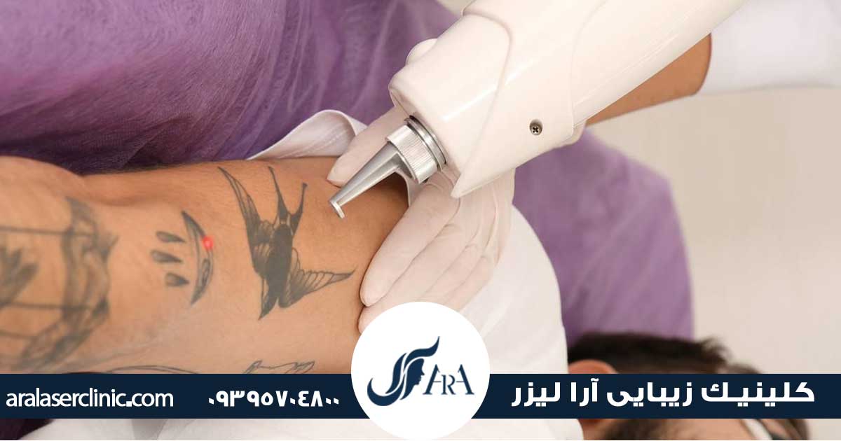 نحوه پاک کردن تاتو در فردیس