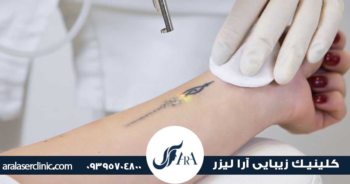 نحوه پاک کردن تاتو در فردیس