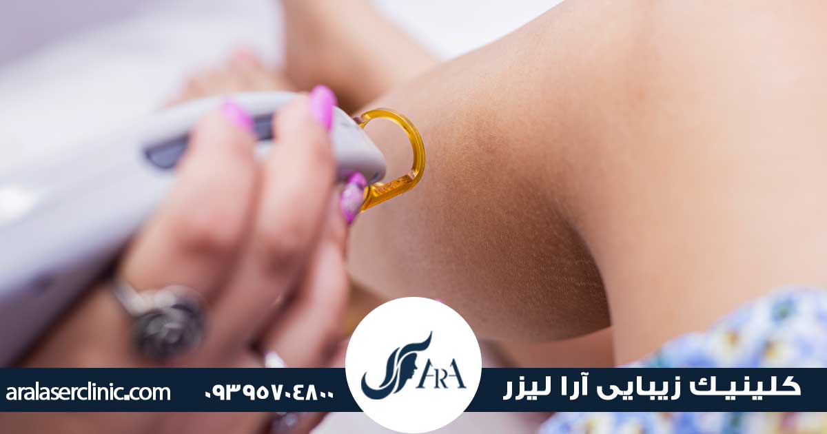 دستگاه لیزر نابلکس